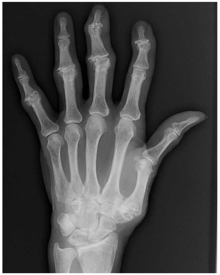 Hand radiograph showing central erosions and gull-wing deformity in erosive osteoarthritis