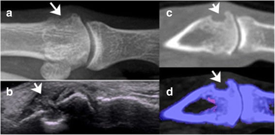 Multimodality gout assessment with radiograph ultrasound CT and dual-energy CT
