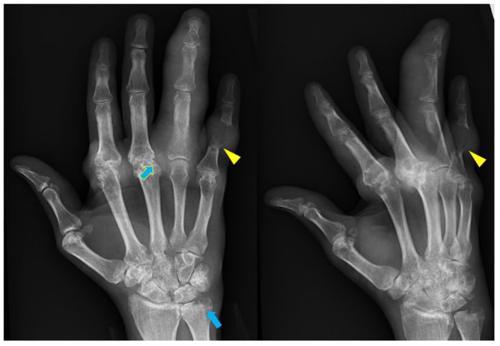 Hand radiographs showing gouty tophi and punched-out erosions with overhanging edges