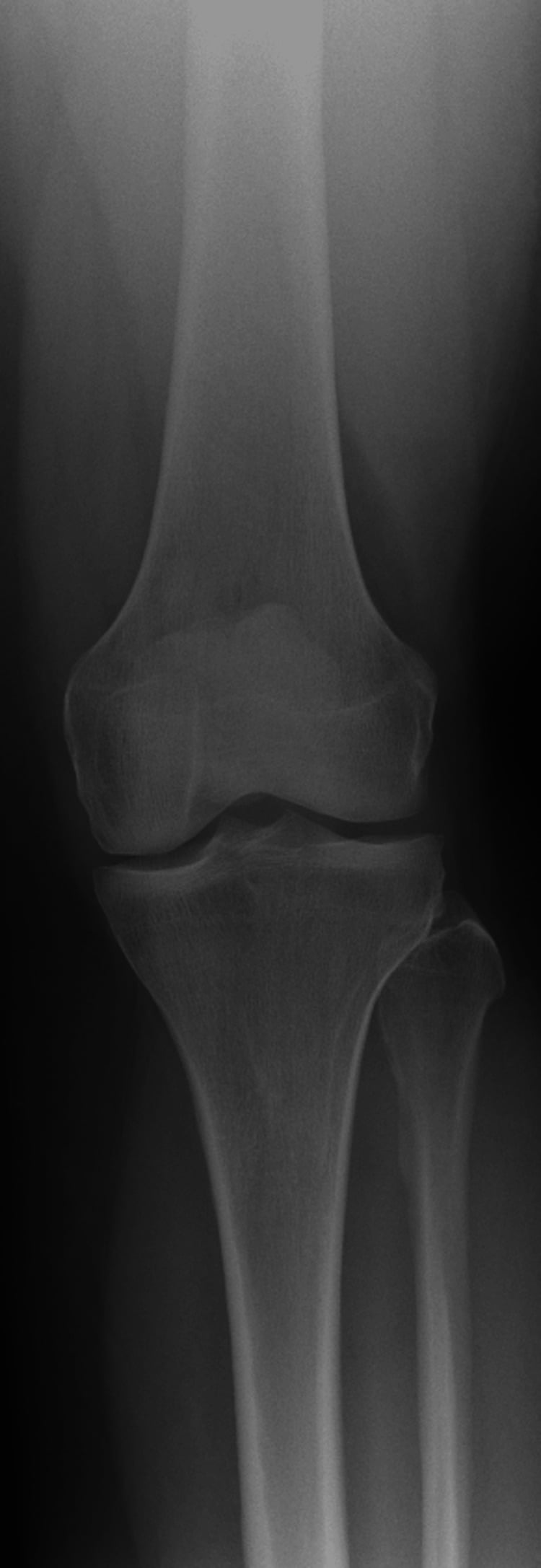 Weight-bearing knee radiograph showing Kellgren-Lawrence grade 2 osteoarthritis