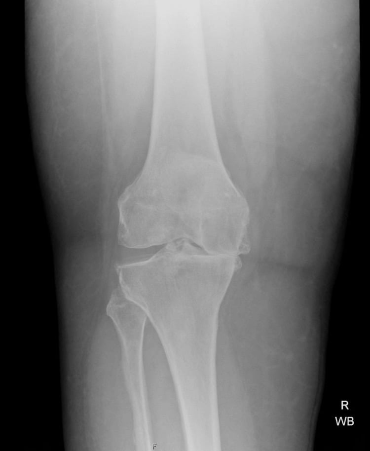 Weight-bearing knee radiograph showing Kellgren-Lawrence grade 4 osteoarthritis