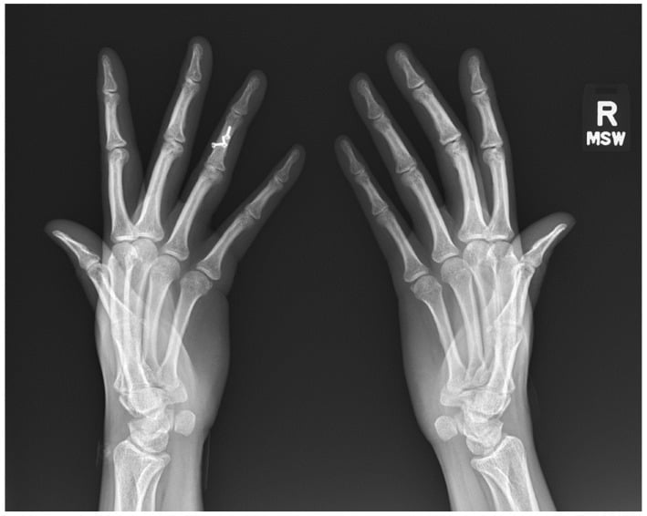 Bilateral Nørgaard ball-catcher hand radiograph for detecting early inflammatory erosions