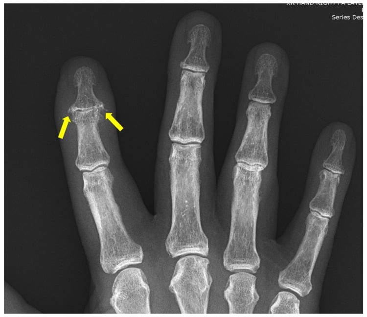 Hand radiograph showing psoriatic dactylitis, DIP erosions and fluffy periostitis