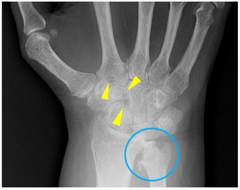 Frontal wrist radiograph showing periarticular demineralisation and scattered erosions in the carpus, distal radius and distal ulna.