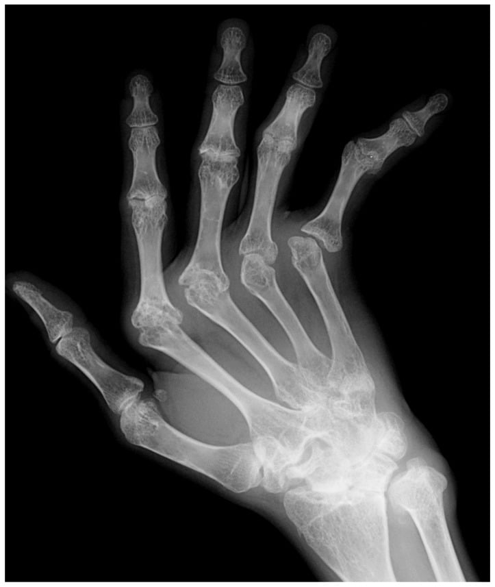 Oblique hand radiograph showing long-standing rheumatoid erosions at the wrist, MCP and PIP joints with ulnar MCP subluxation and DIP sparing.