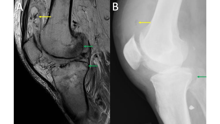 Knee MRI and lateral radiograph showing advanced septic arthritis with gas