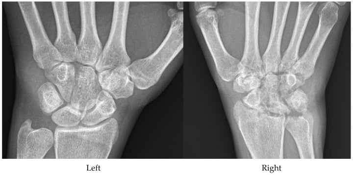 Bilateral wrist radiographs showing unilateral erosive septic arthritis