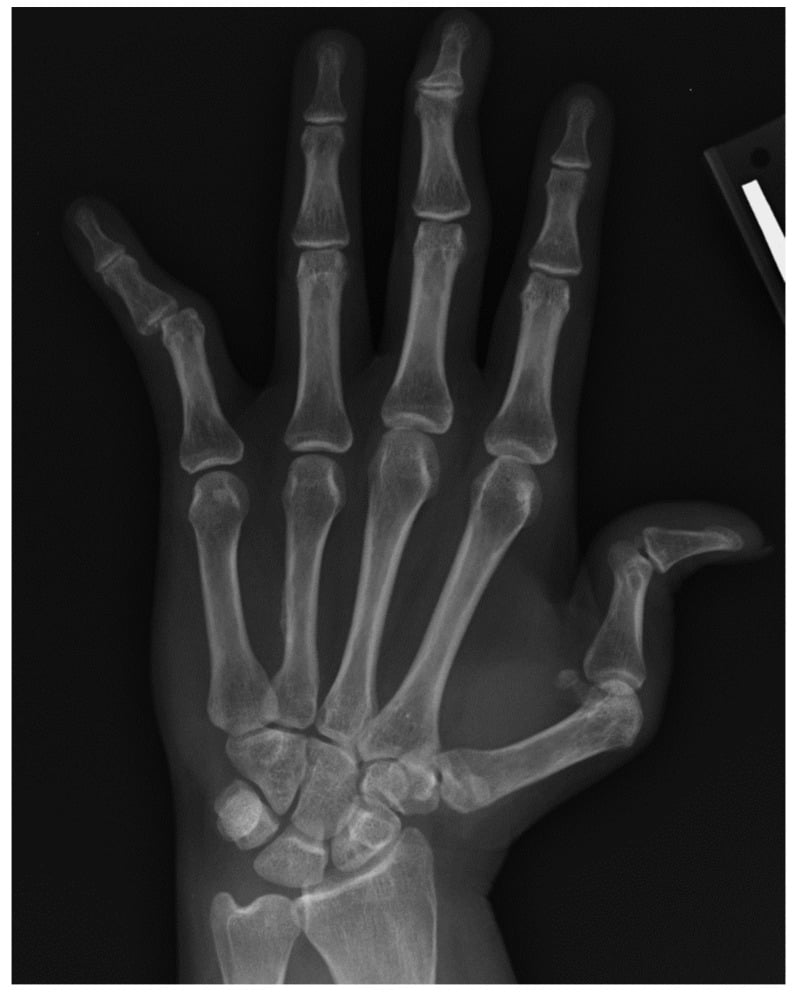 Hand radiograph showing non-erosive Jaccoud deformity in systemic lupus