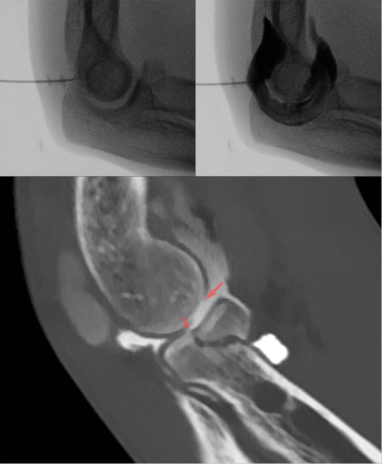 Fluoroscopic contrast injection into the elbow and a corresponding sagittal CT arthrogram outlining a radial head fragment.