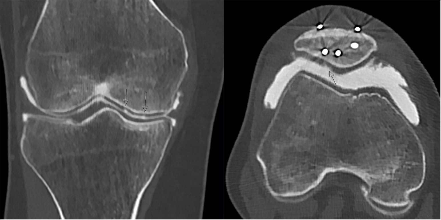 Coronal and axial CT arthrogram of the knee with contrast outlining the articular cartilage and a patellar chondral defect.