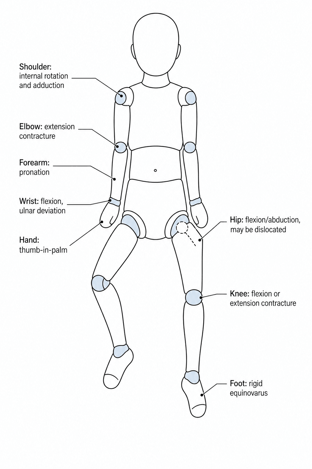Illustration of the classic symmetric joint contracture pattern in Amyoplasia