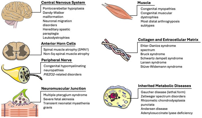 Illustrated map of central, anterior-horn-cell, peripheral-nerve, neuromuscular-junction, muscle, connective-tissue and metabolic causes of arthrogryposis.
