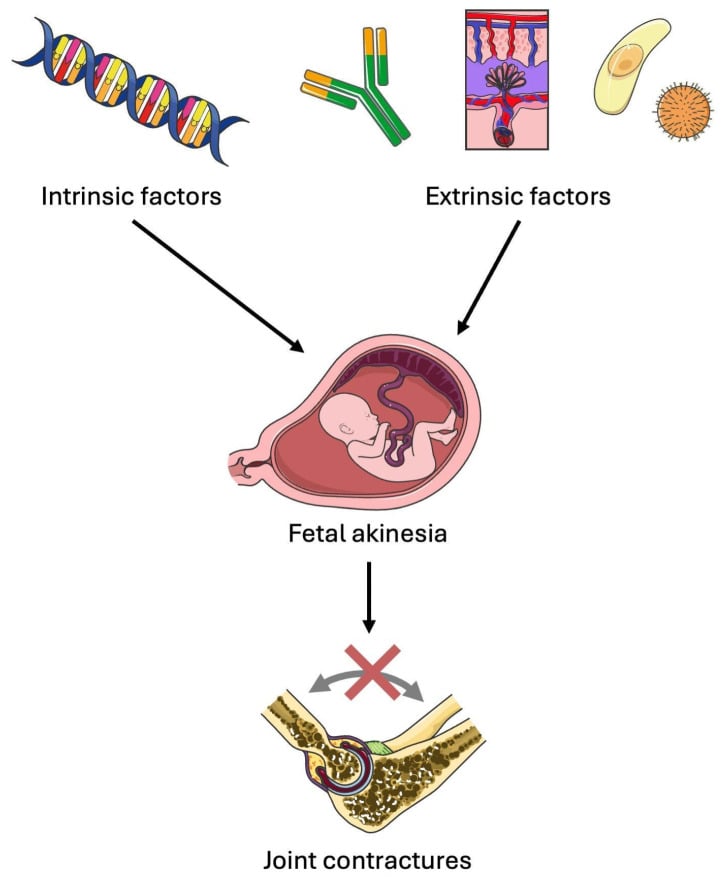 Diagram showing intrinsic and extrinsic factors converging on fetal akinesia, which leads to joint contractures.