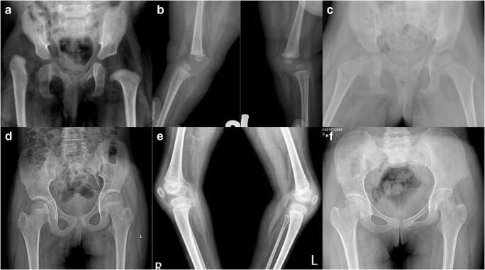 Serial pelvic and knee radiographs showing congenital hip and knee dislocation and later correction in a child with arthrogryposis.