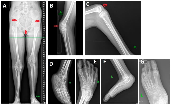 Standing long-leg, lateral knee and foot radiographs in PITX1-related syndromic arthrogryposis, with arrows marking the pelvis and knees.