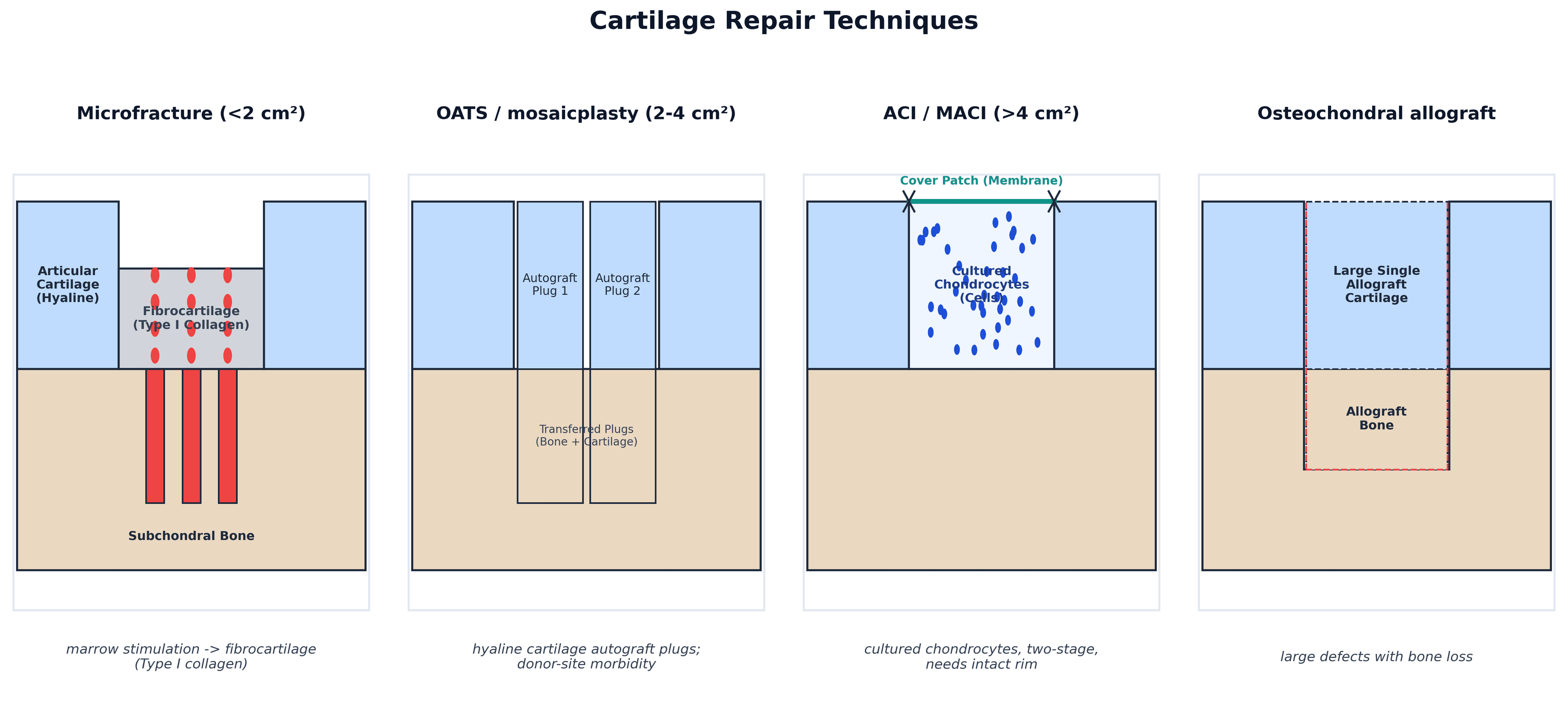 Cross-section diagram comparing microfracture, OATS, ACI/MACI and osteochondral allograft cartilage repair techniques
