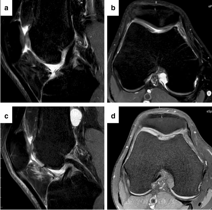 Preoperative and one-year postoperative knee MRI showing complete fill of a trochlear grade IV cartilage defect