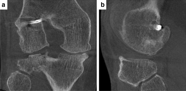 Coronal and sagittal CT showing the complication of intralesional osteophytes five years after knee microfracture