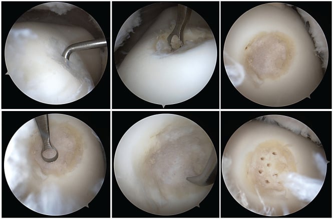 Six-step arthroscopic sequence of trochlear cartilage probing, debridement, measurement and microfracture