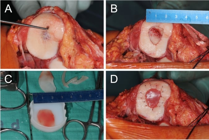 Four-panel operative sequence of retropatellar cartilage probing, debridement, scaffold sizing and MACI implantation