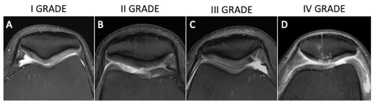 Axial fat-suppressed proton-density MRI examples of patellofemoral cartilage damage from Outerbridge grades I to IV