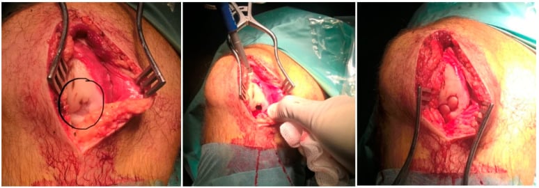 Three operative photographs showing the surgical OATS technique: an osteochondral defect, donor plug harvest and loaded graft plugs