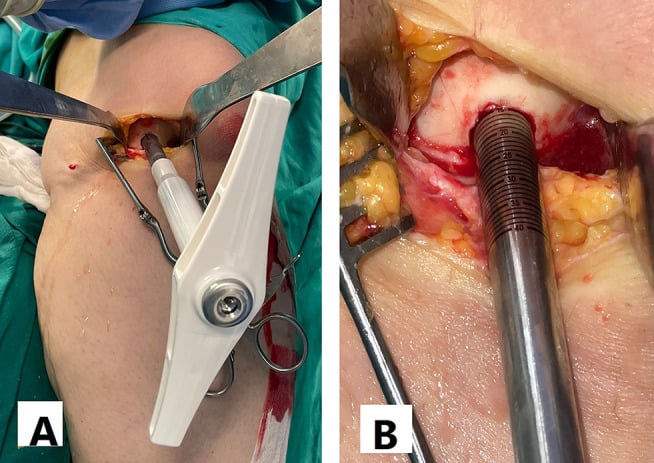 Operative sequence showing a lateral femoral condyle defect, donor sizing and two overlapping osteochondral allograft dowels