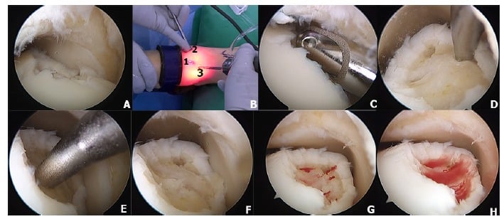 Eight-panel arthroscopic sequence showing portal placement, debridement and microfracture of a medial talar osteochondral lesion