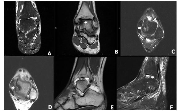 Coronal and axial MRI examples of medial osteochondral lesions of the talus at different locations and stages