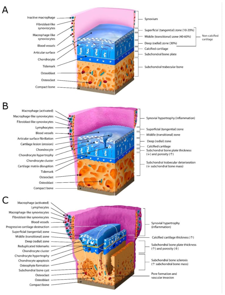 Schematic showing articular cartilage zones in normal and osteoarthritic states