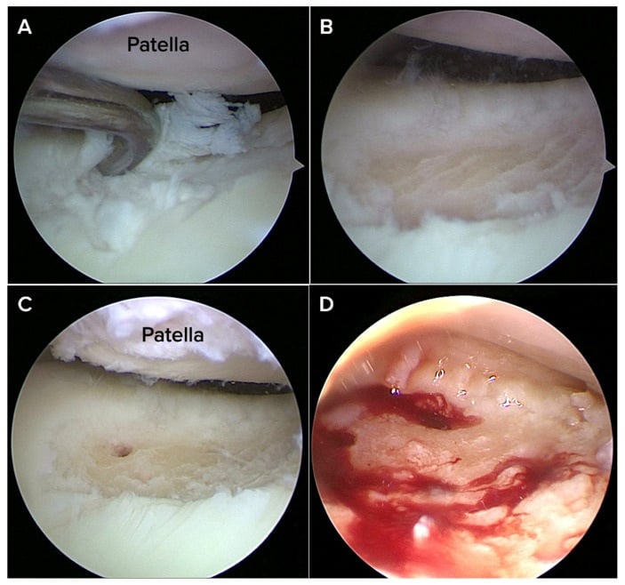 Arthroscopic sequence of grade four trochlear cartilage defect preparation and marrow perforation
