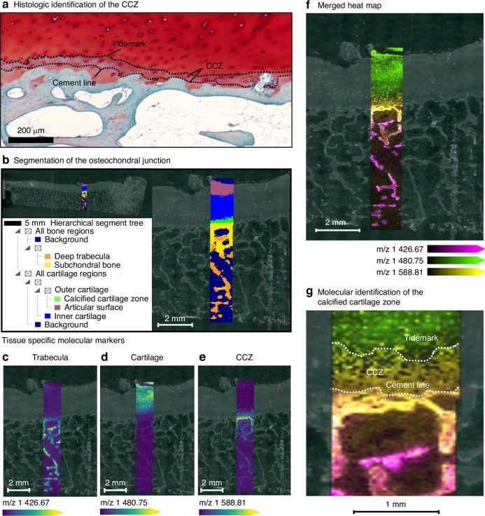 Human osteochondral junction histology showing tidemark cement lines and calcified cartilage