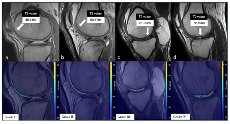 Knee MRI and T2 maps across chondropathy grades one to four