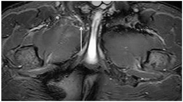 Axial oblique proton-density fat-suppressed MRI showing right adductor longus tendinopathy
