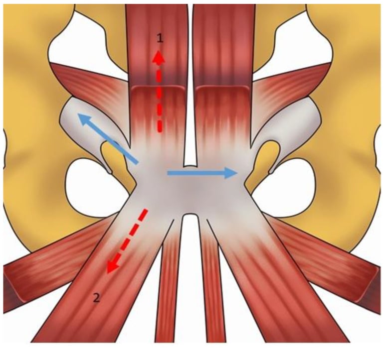 Pelvic schematic showing rectus-abdominis and adductor force vectors across the pubic symphysis