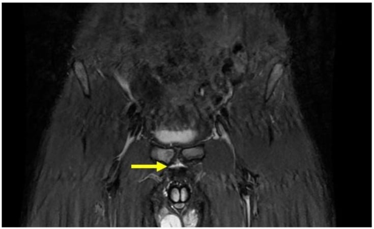 Coronal STIR MRI showing avulsion of the adductor-longus rectus-abdominis prepubic aponeurotic plate