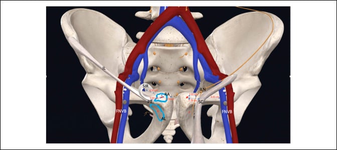 Anterior pelvic surgical anatomy illustration showing rectus-abdominis and adductor-longus footprints with nearby nerves and vessels