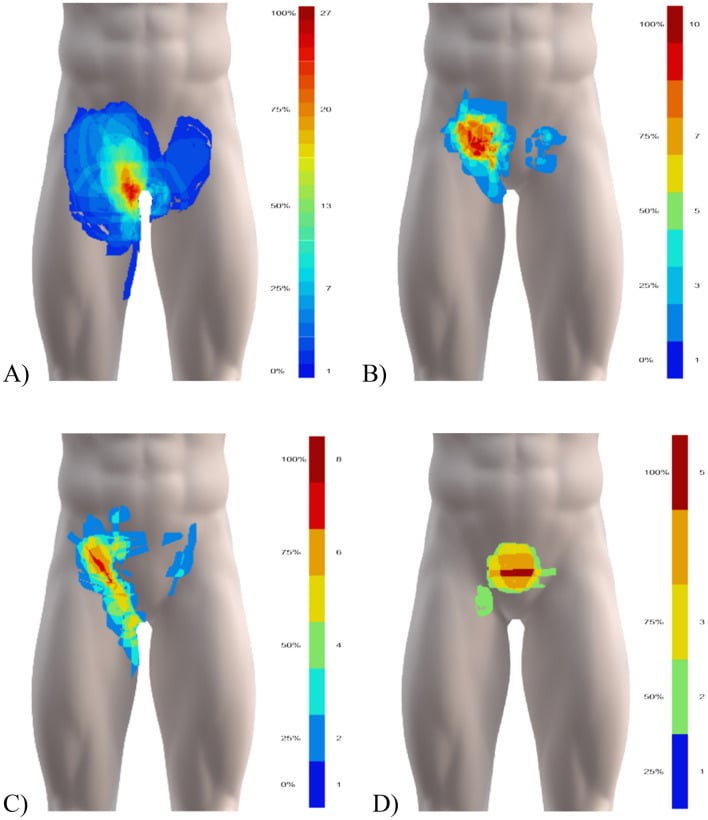 Doha classification system pain maps for adductor-, inguinal-, iliopsoas- and pubic-related groin pain
