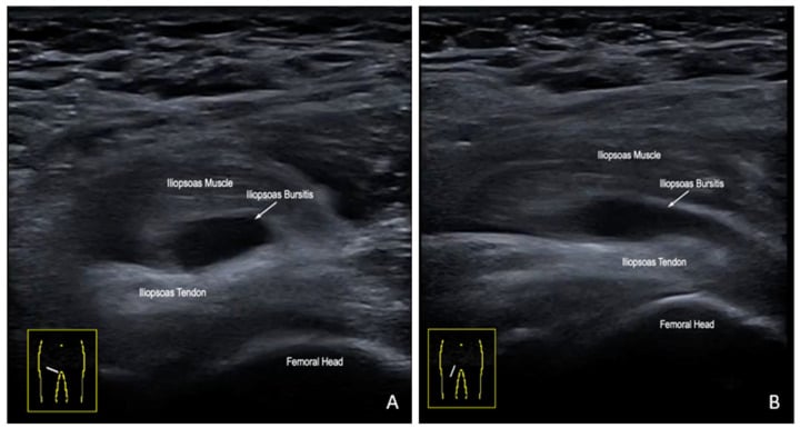 Transverse and longitudinal ultrasound showing fluid distension of the iliopsoas bursa