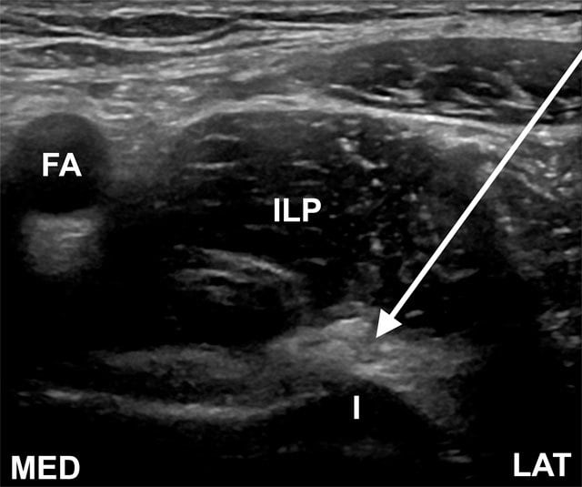 Transverse oblique ultrasound showing a needle approaching deep to the iliopsoas tendon