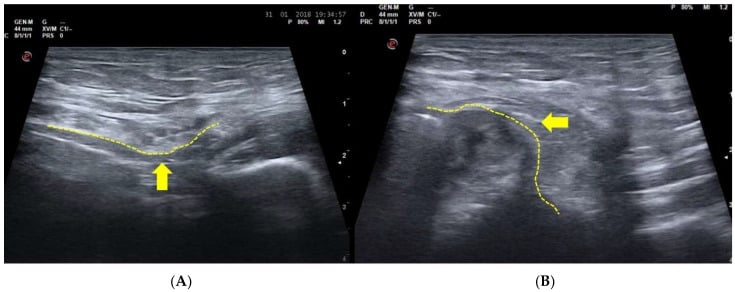 Paired dynamic ultrasound of the inguinal canal at rest and during Valsalva showing posterior-wall bulging