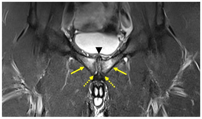 Coronal STIR MRI showing central symphyseal disc protrusion, bilateral marrow oedema and irregular pubic margins