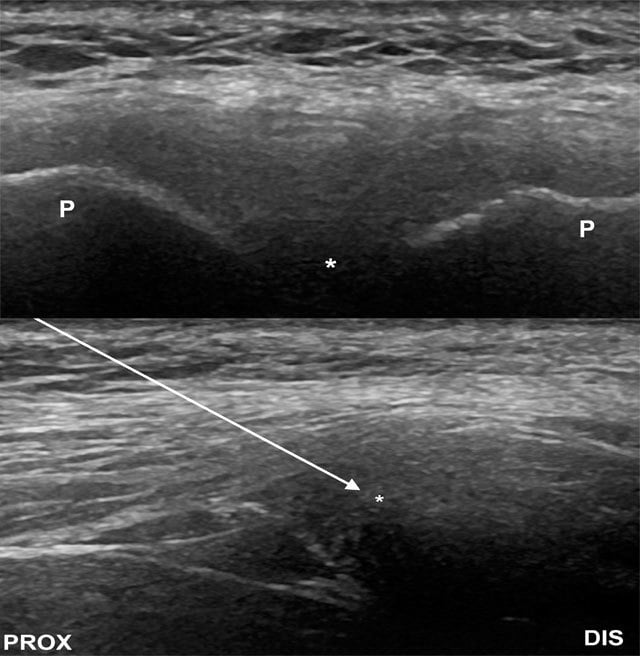 Transverse and sagittal ultrasound views showing a superior in-plane needle approach to the pubic symphysis