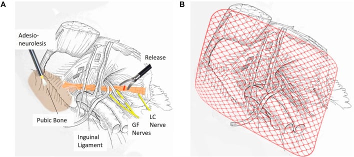 Two-stage schematic of endoscopic totally extraperitoneal sports-hernia release and mesh reinforcement