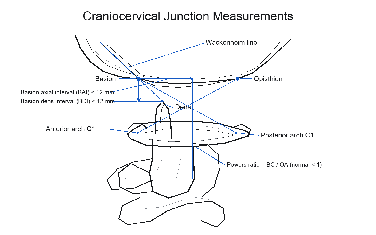 Lateral craniocervical junction diagram showing the basion, opisthion, dens and C1 arches with the Wackenheim line, basion-dens interval, basion-axial interval and Powers ratio lines.