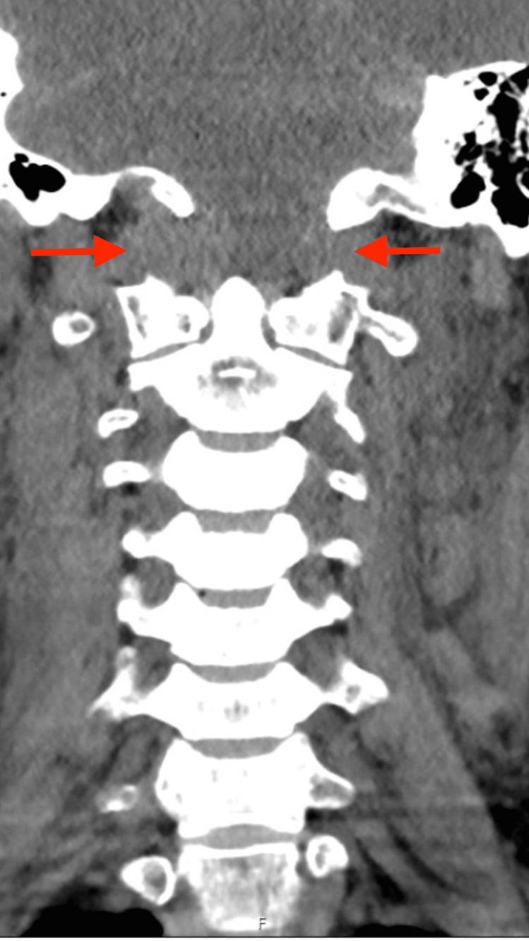 Coronal CT reconstruction showing bilateral widening of the occiput-C1 joint spaces in atlanto-occipital dissociation.