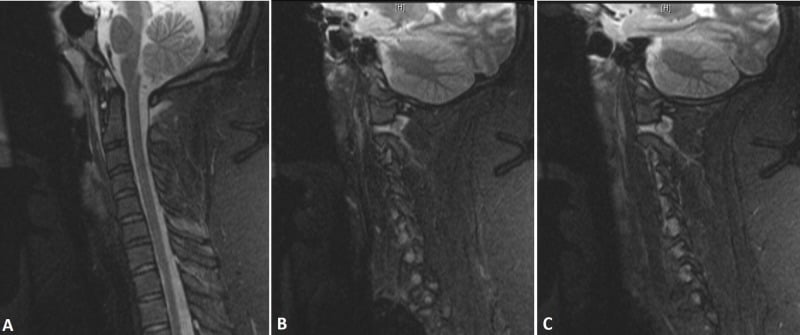 Sagittal and bilateral parasagittal STIR MRI showing apical ligament disruption, abnormal basion-dens interval and craniocervical joint oedema.