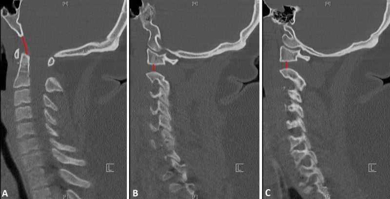 Sagittal and bilateral parasagittal CT showing atlanto-occipital dissociation with abnormal basion interval and atlantoaxial distraction despite normal CCI.