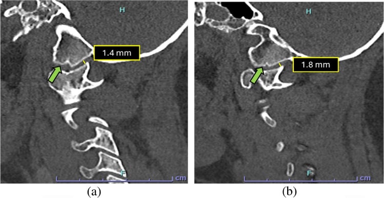 Right and left parasagittal CT images demonstrating normal occipital-condyle to C1 interval measurements.