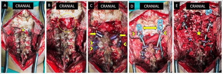 Sequential posterior occipitocervical operative views showing exposure, decompression, cervical screw placement and occipital plate-rod fixation.